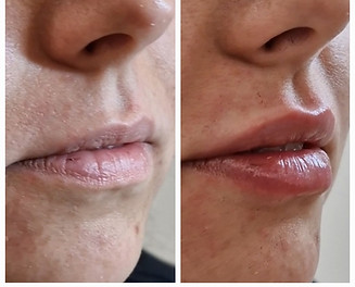 dermal filler lips 1.jpg