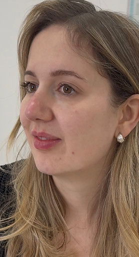 natural filler results manchester after_edited.jpg