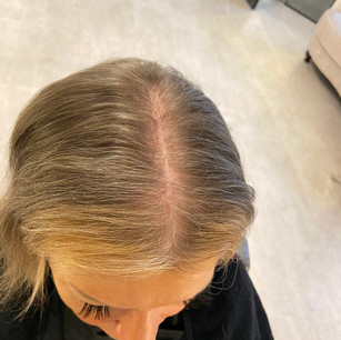 Before Image - Hair Thinning