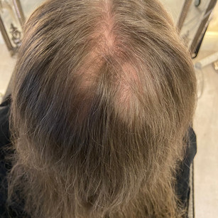 Before Image - Hair Thinning