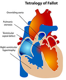 Tetralogy_of_Fallot_edited.jpg