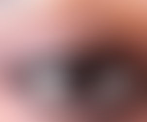 les causes réelles des cernes, leurs différents types et les solutions efficaces pour retrouver un regard lumineux.