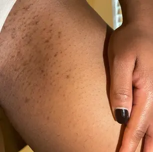 5 Astuces Pour un Joli Bikini :  Adieu  taches et Hyperpigmentation