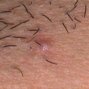 Comment  éliminer les poils incarnés ?