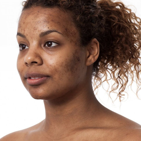 Taches pigmentaires sur peau noire et métissée