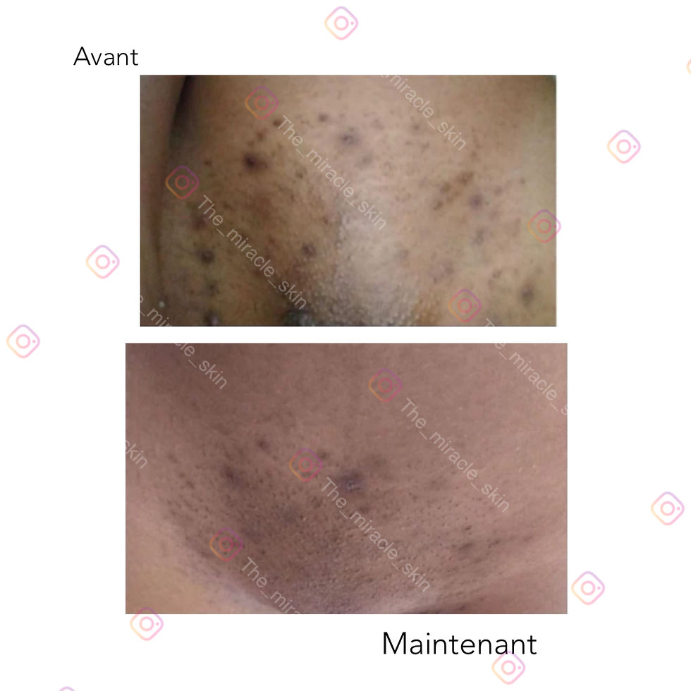 Miniature : Avant-après traitement des taches et poils incarnés modérés sur la zone intime