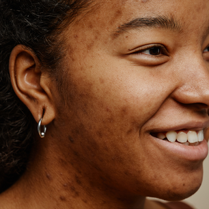 Pourquoi mes taches pigmentaires mettent du temps à disparaître ?