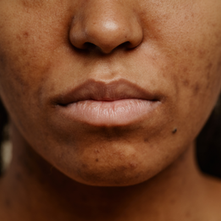 Acné hormonale: comment la reconnaître et adapter sa routine