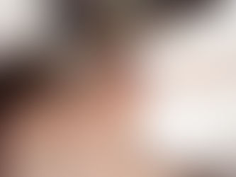 How to Maintain Results Post Hair Transplant in Dubai