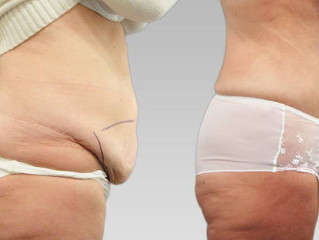 Dubai’s Leading Tummy Tuck Experts
