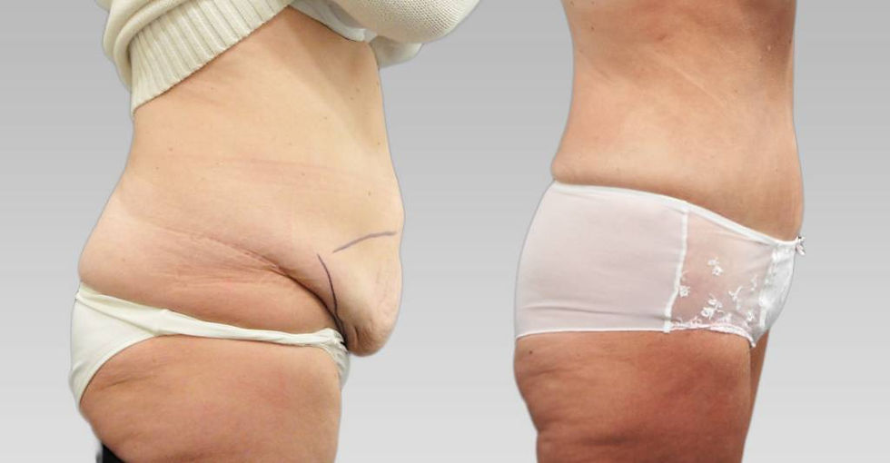 Tummy Tuck in Dubai