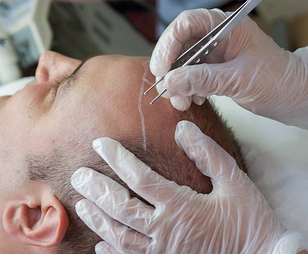 Hair transplant in Dubai