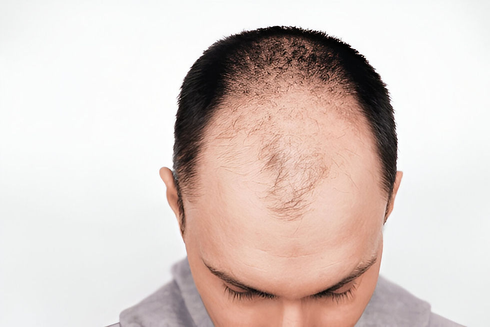 زراعة الشعر في دبي