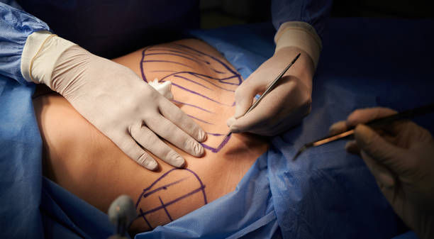 tummy tuck in Dubai