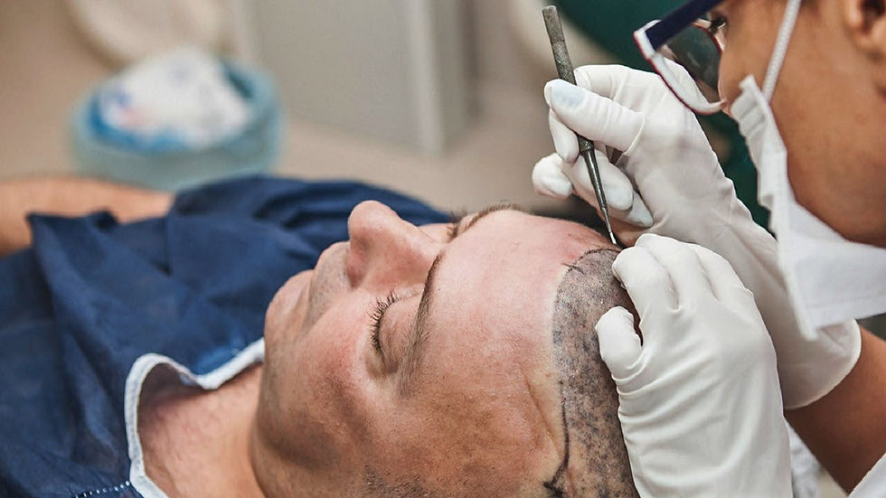 hair transplant in Dubai