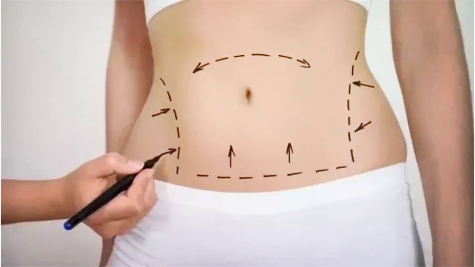 Liposuction Surgery in Dubai