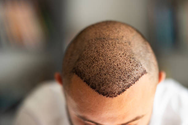 زراعة الشعر في دبي