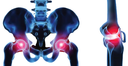 Hip and Knee