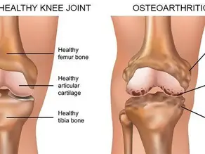 Osteoarthritis Knee