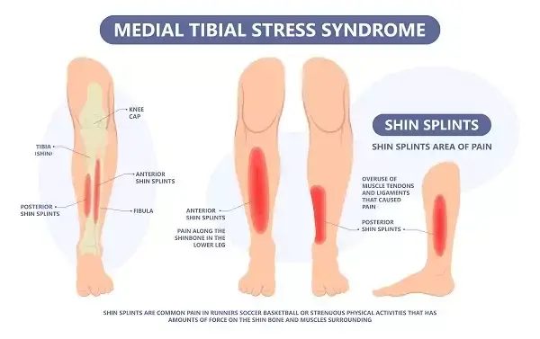 Shin Splints in Runners: Causes, Prevention, and Best Exercises for Recovery