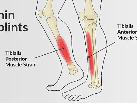 Shin Splints 