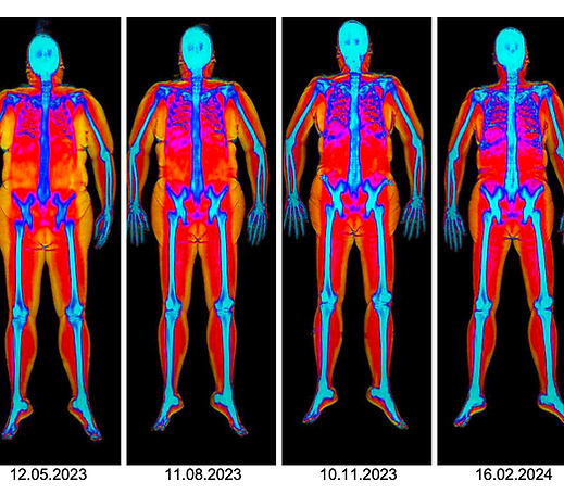 DEXA Scan Xray