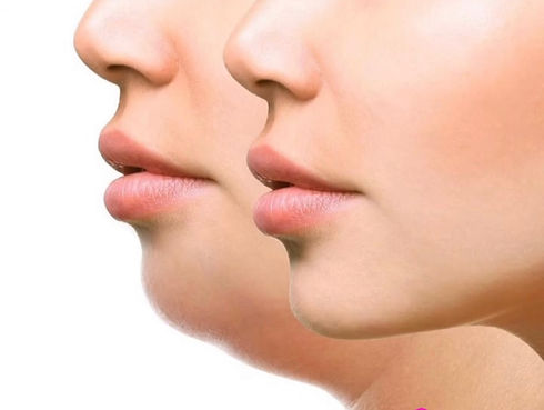 Bliss Health And Wellness, Facial Treatments, Dr. Quaynor, Alderwood Lynnwood, Seattle, Botox, Neurotoxin, Vitamins Injections, Kybella, Microneedling, Facial Fillers, Black Owned Business