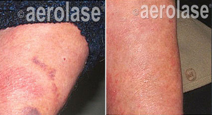 body arms Psoriasis Before & After 