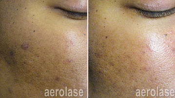 Pigmented Lesions -(Dark Spots) Before and After skin of color laser treatments