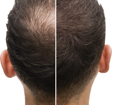 hair-loss-treatment-pic-1.png