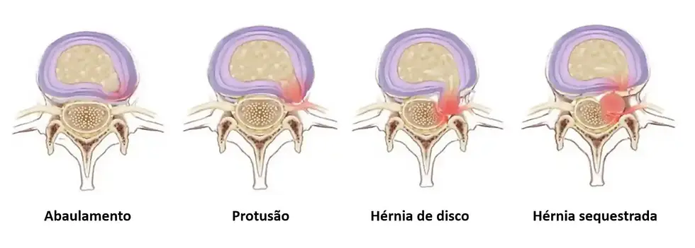 herniadediscoprotusaoabaulamentoherniadediscoherniasequestrada.webp