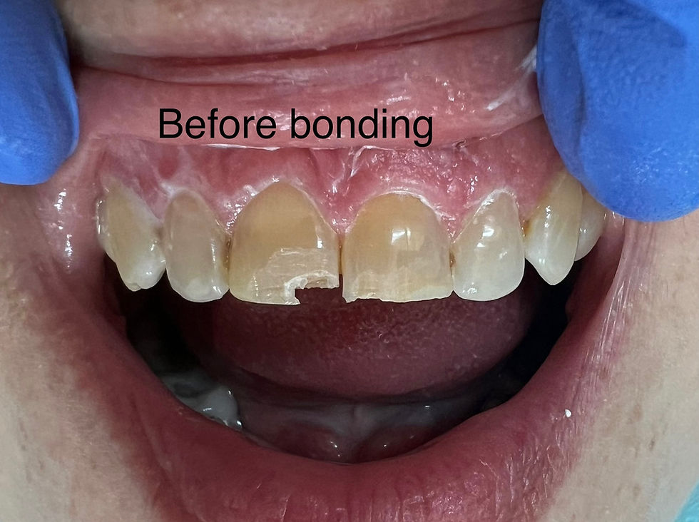 Before dental restoration treatment Caledonia Dental Group MI