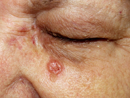 Basal Cell Cancer: Symptoms and Causes