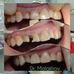 🤗🏥📷Прямая реставрация зуба 1