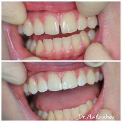 Прямая реставрация 1.1-2.1 зубов