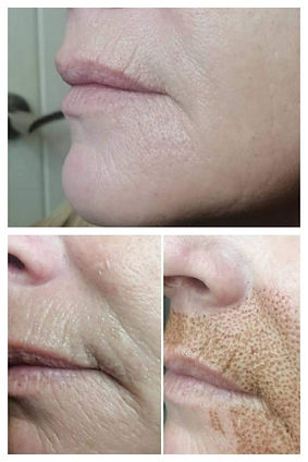 Before and after lip.jpg