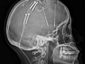 Electrodos en el cerebro para vencer la depresión: HIC realiza cirugía pionera con resultados asombrosos