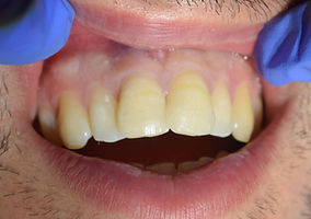 Broken Teeth Restoration