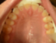 After Invisalign case 3
