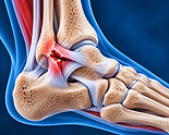 Lesión del ligamento lateral del tobillo.png
