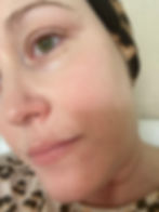 A close up of hyperpigmentation from chemotherapy on a woman's face