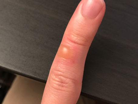 I burnt my finger
