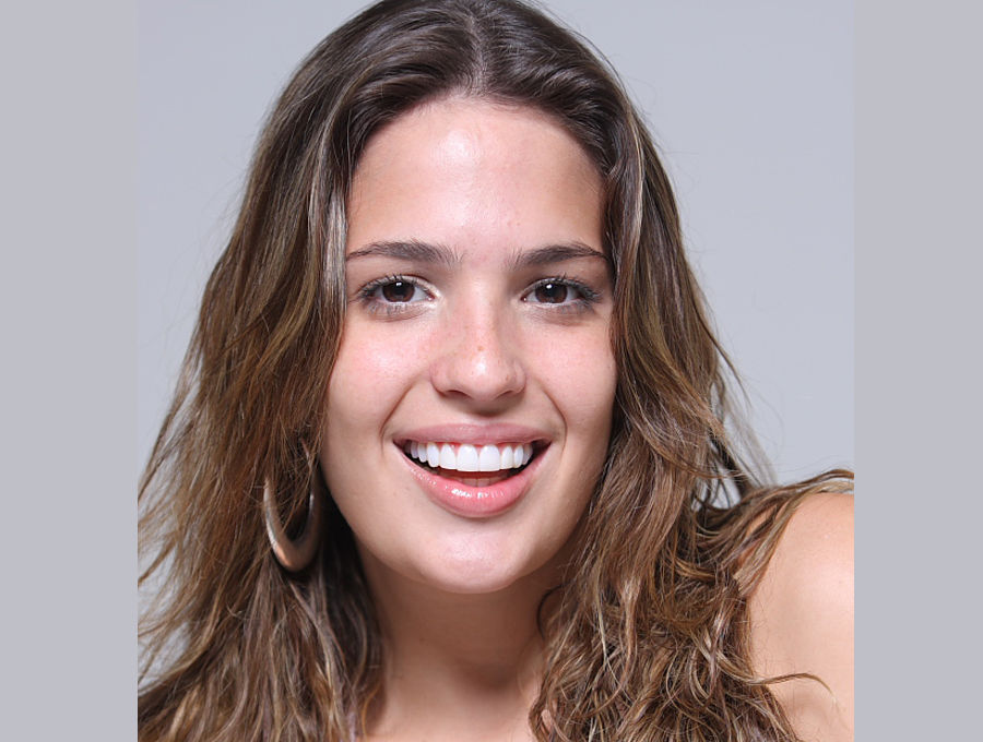Facetas, Estética