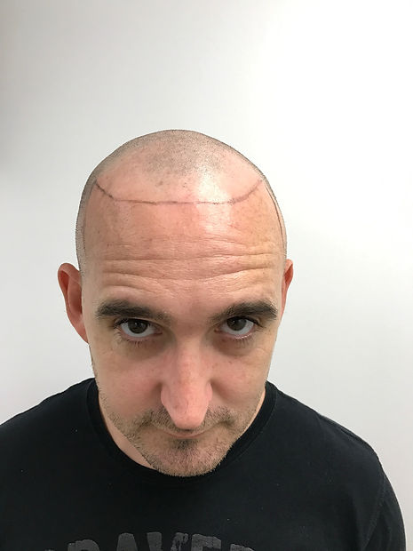 Scalp Micropigmentation Australia Before