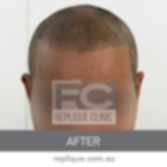 Hair Loss Solutions Hair Tattoo Brisbane