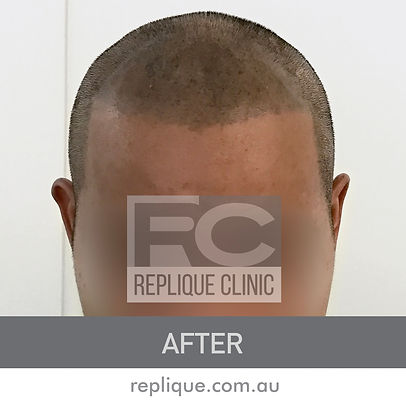 Hair loss solutions Brisbane Hair tattoo