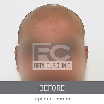 Scalp Micropigmentation Brisbane Before and after