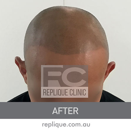 Hair Loss Solutions Hair Tattoo Brisbane