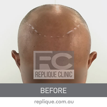 Hair Loss Solutions Hair Tattoo Brisbane
