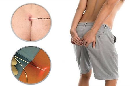 Κύστη κόκκυγα (4).jpg